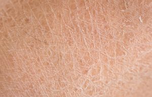 Сухость кожи: причины, симптомы, лечение