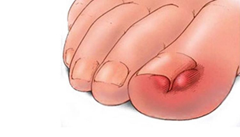 Лечение грибковых заболеваний ногтей