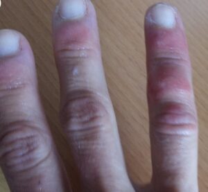 Артрит пальцев рук: симптомы и лечение